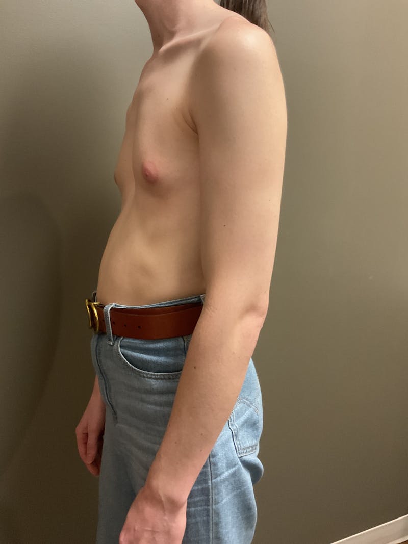 Breast Augmentation Before & After Gallery - Patient 331459 - Image 5