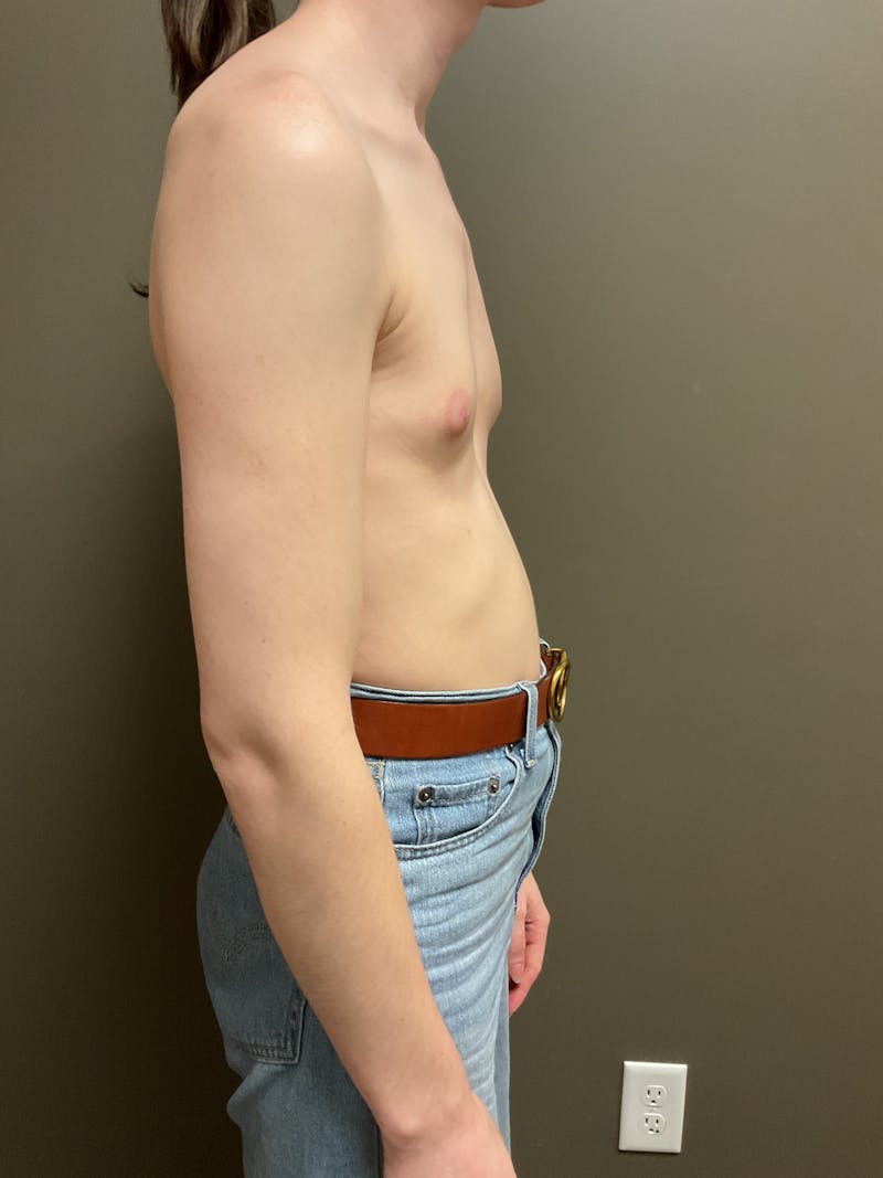 Breast Augmentation Before & After Gallery - Patient 331459 - Image 7