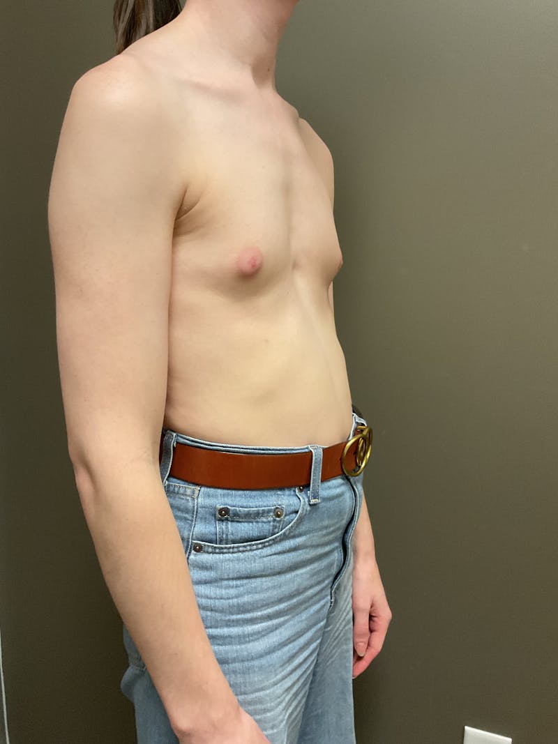 Breast Augmentation Before & After Gallery - Patient 331459 - Image 9