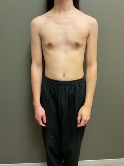 Breast Augmentation Before & After Gallery - Patient 220688 - Image 1