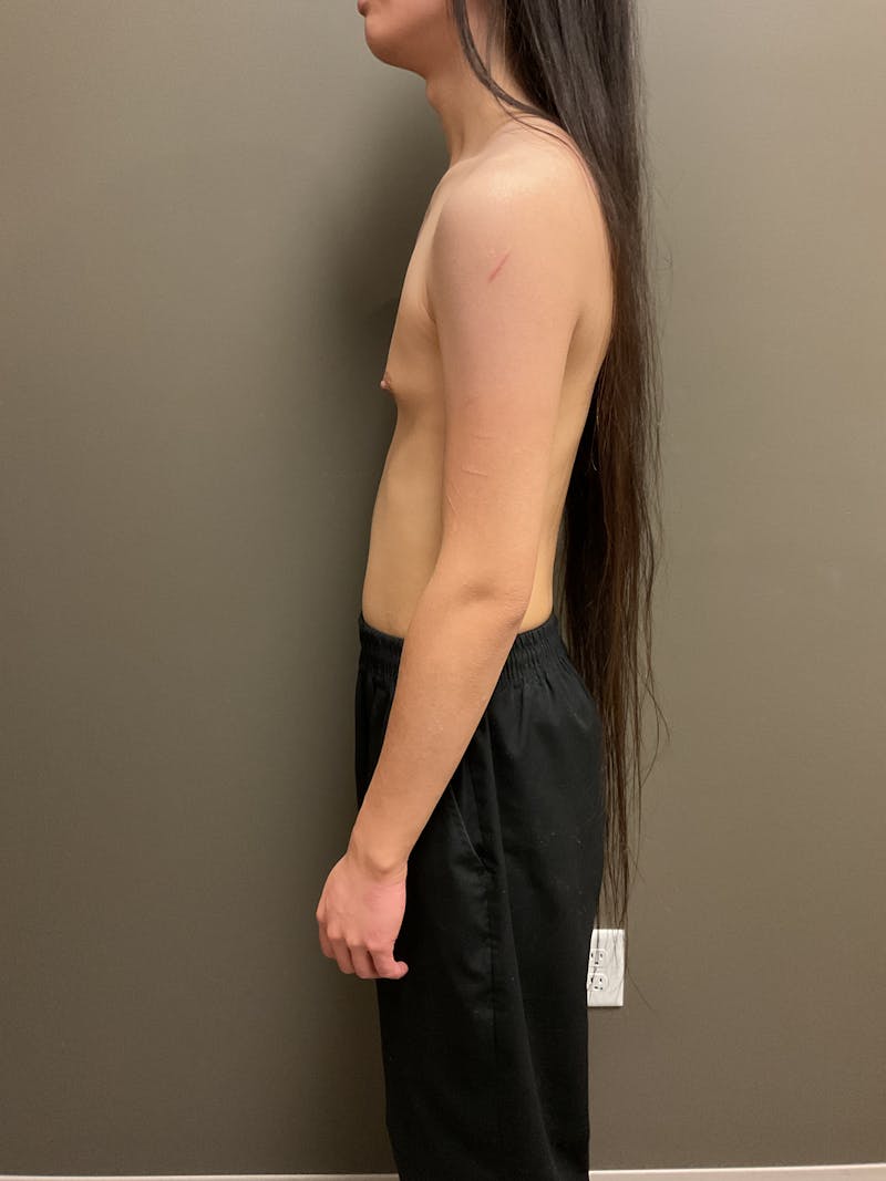 Breast Augmentation Before & After Gallery - Patient 220688 - Image 3