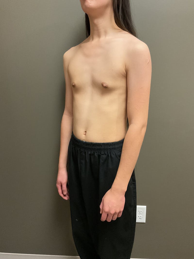 Breast Augmentation Before & After Gallery - Patient 220688 - Image 5