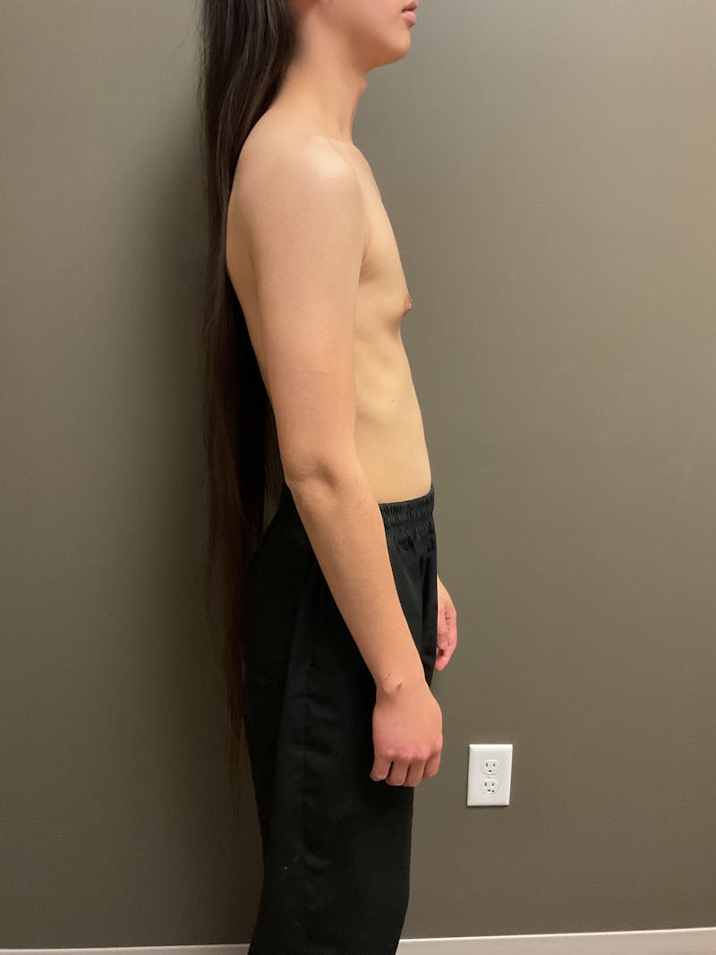 Breast Augmentation Before & After Gallery - Patient 220688 - Image 7