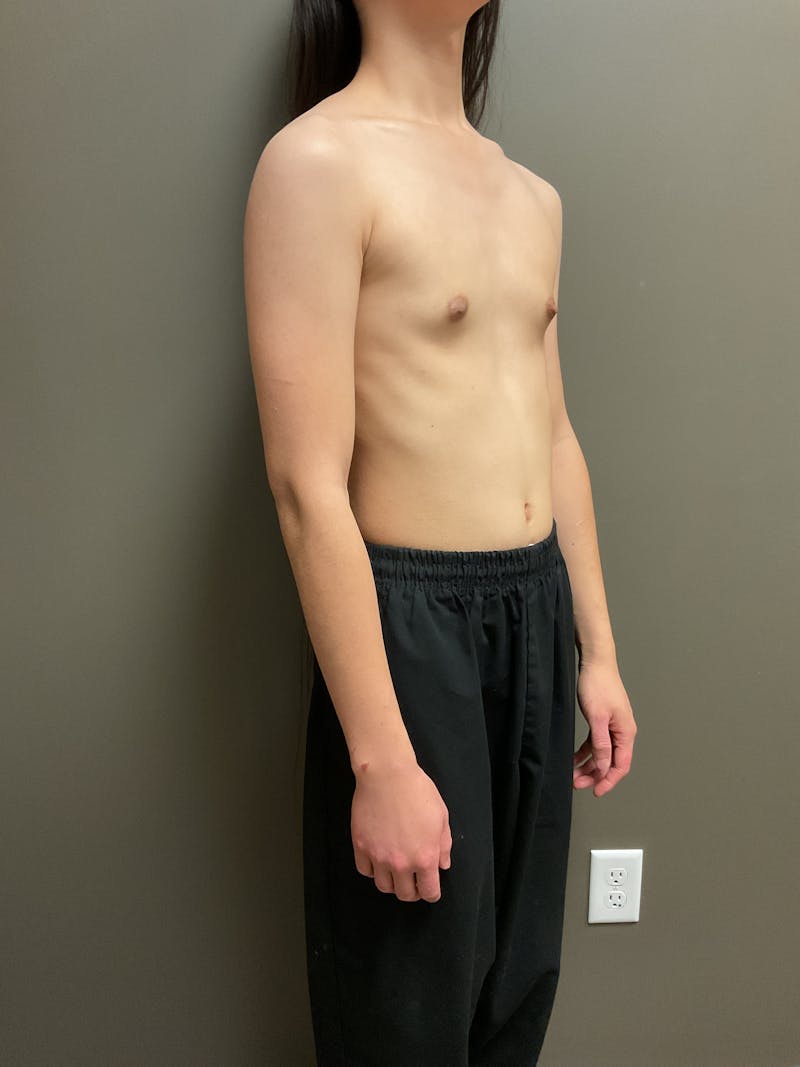 Breast Augmentation Before & After Gallery - Patient 220688 - Image 9