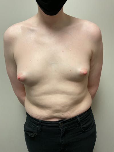 Breast Augmentation Before & After Gallery - Patient 318261 - Image 1