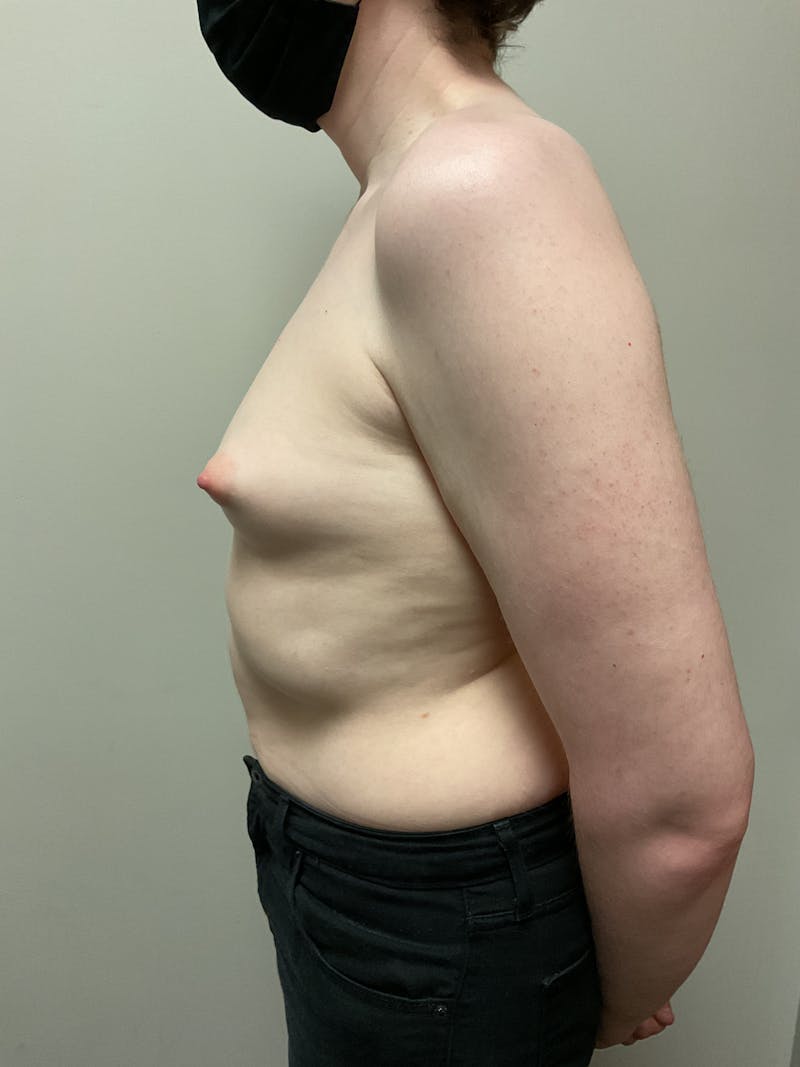 Breast Augmentation Before & After Gallery - Patient 318261 - Image 3