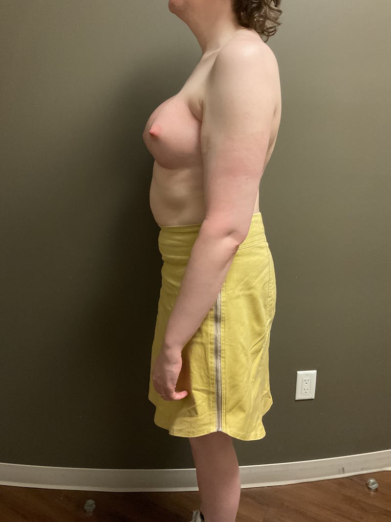 Breast Augmentation Before & After Gallery - Patient 318261 - Image 4