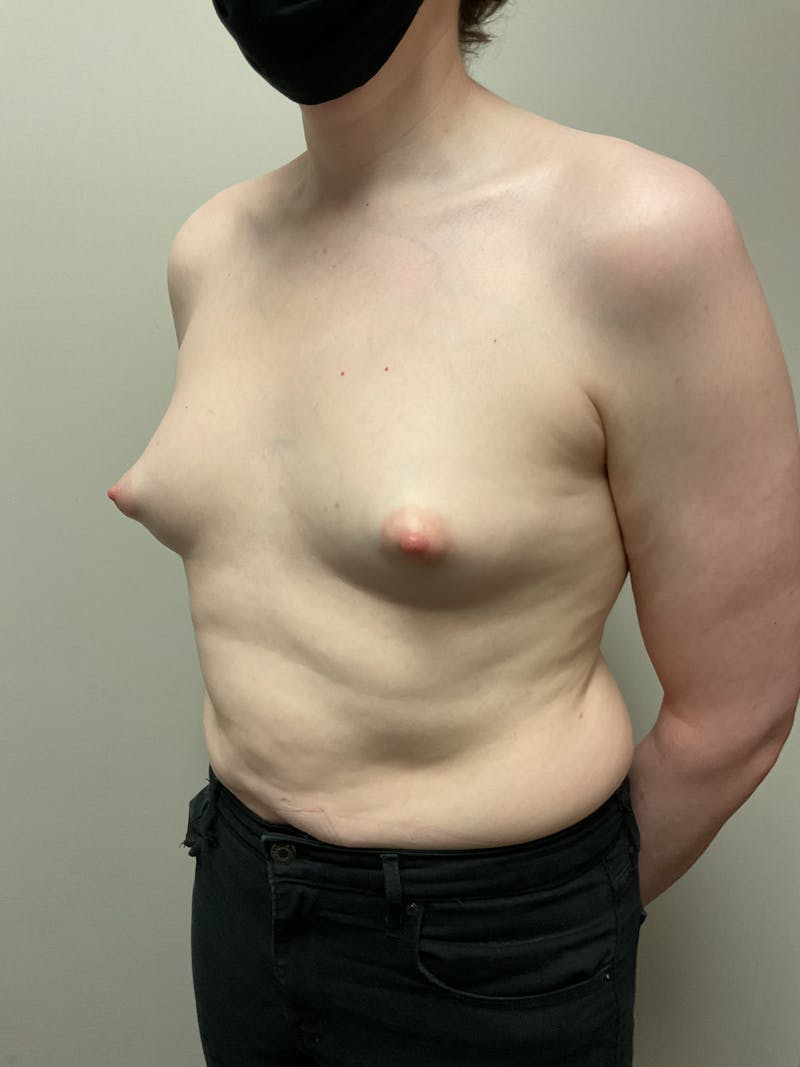 Breast Augmentation Before & After Gallery - Patient 318261 - Image 5