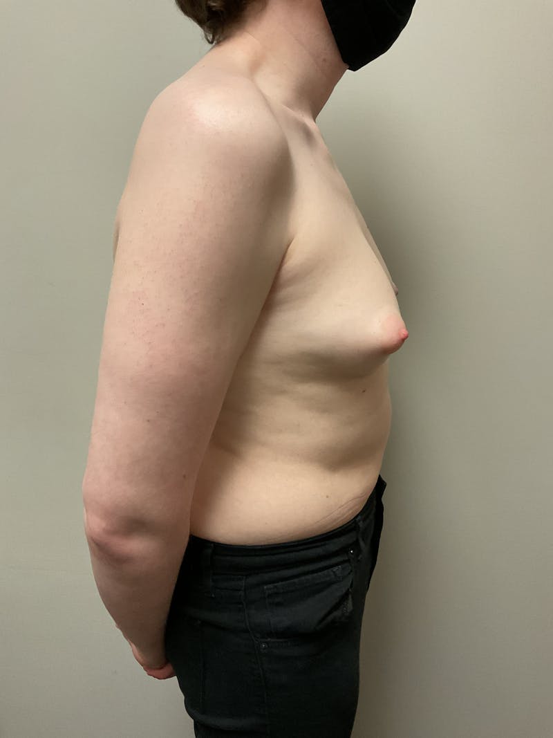 Breast Augmentation Before & After Gallery - Patient 318261 - Image 7