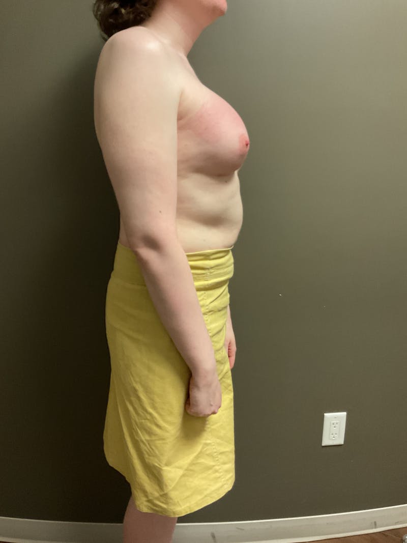 Breast Augmentation Before & After Gallery - Patient 318261 - Image 8