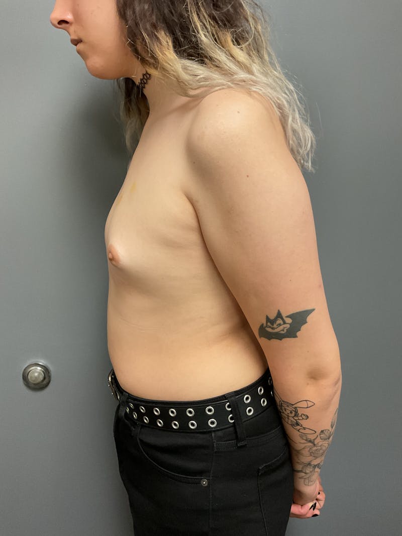 Breast Augmentation Before & After Gallery - Patient 179313 - Image 3