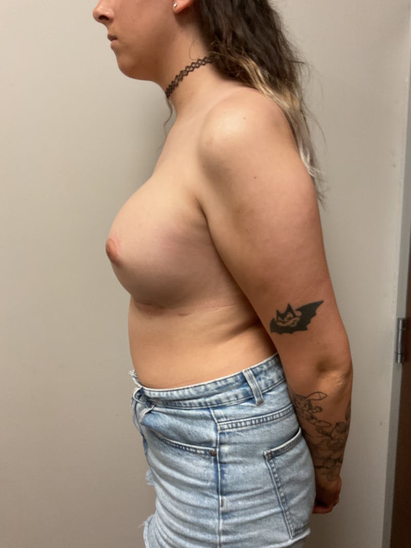 Breast Augmentation Before & After Gallery - Patient 179313 - Image 4