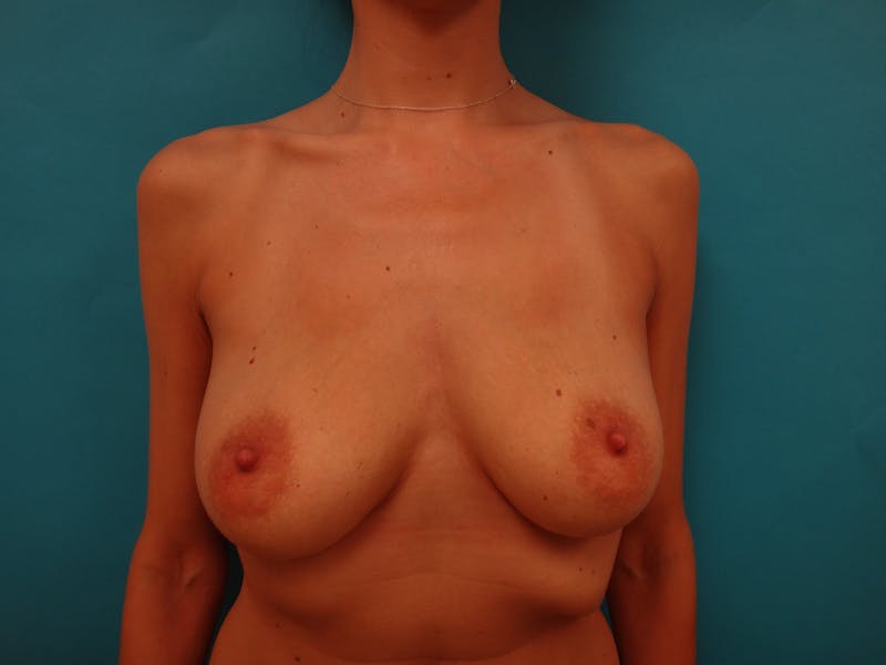 Breast Augmetation and Lift Before & After Gallery - Patient 124159 - Image 1