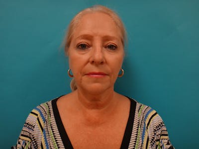 Facelift Before & After Gallery - Patient 340737 - Image 1