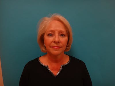 Facelift Before & After Gallery - Patient 340737 - Image 2
