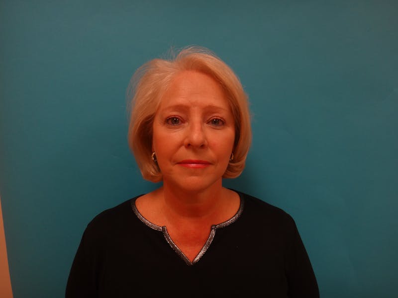 Facelift Before & After Gallery - Patient 340737 - Image 2