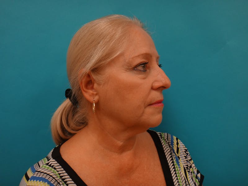 Facelift Before & After Gallery - Patient 340737 - Image 3