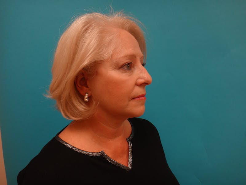 Facelift Before & After Gallery - Patient 340737 - Image 4