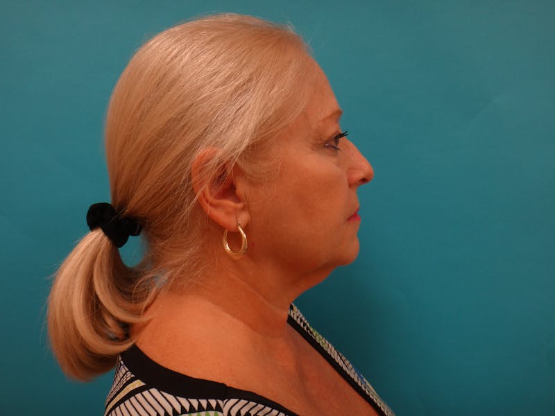 Facelift Before & After Gallery - Patient 340737 - Image 5