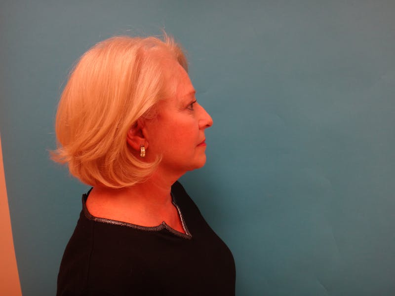 Facelift Before & After Gallery - Patient 340737 - Image 6