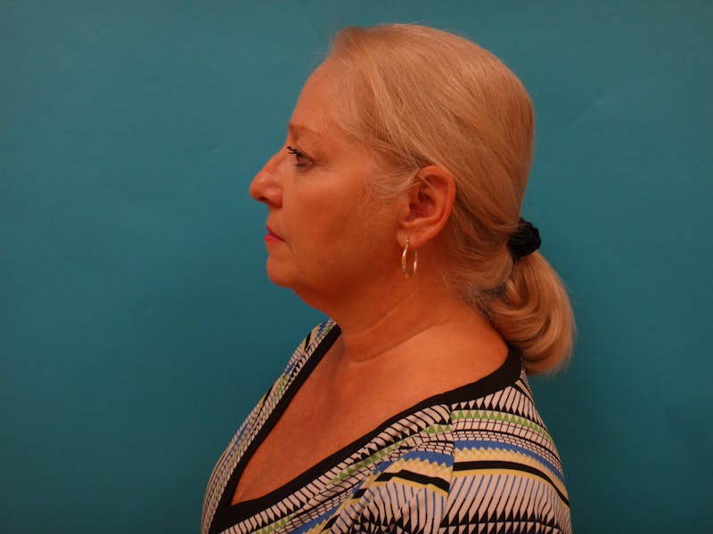 Facelift Before & After Gallery - Patient 340737 - Image 7