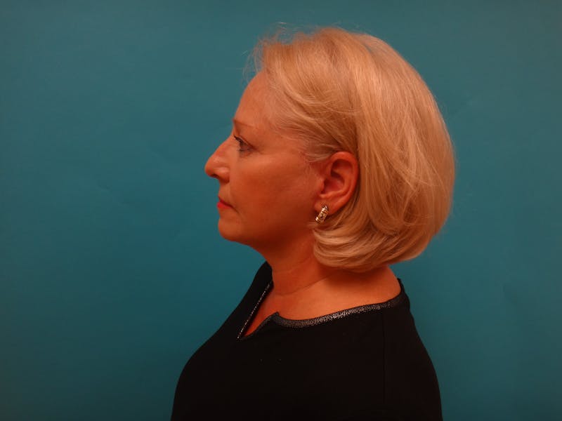 Facelift Before & After Gallery - Patient 340737 - Image 8