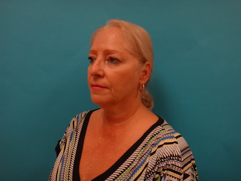 Facelift Before & After Gallery - Patient 340737 - Image 9