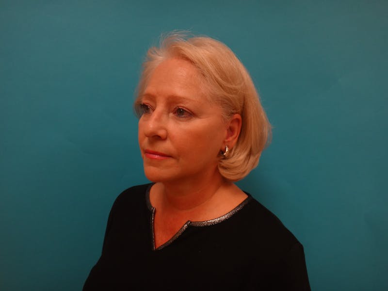 Facelift Before & After Gallery - Patient 340737 - Image 10