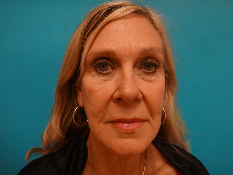 Facelift Before & After Gallery - Patient 261903 - Image 1