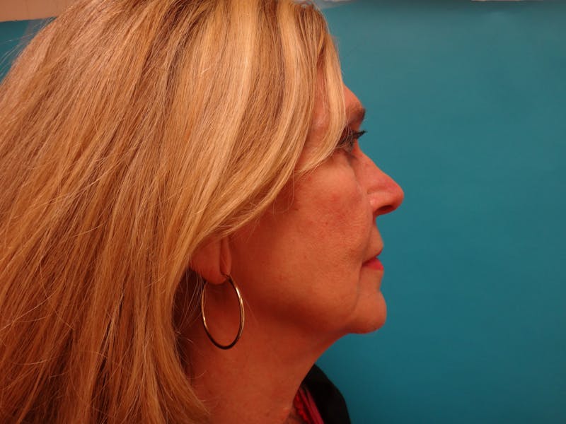 Facelift Before & After Gallery - Patient 261903 - Image 3