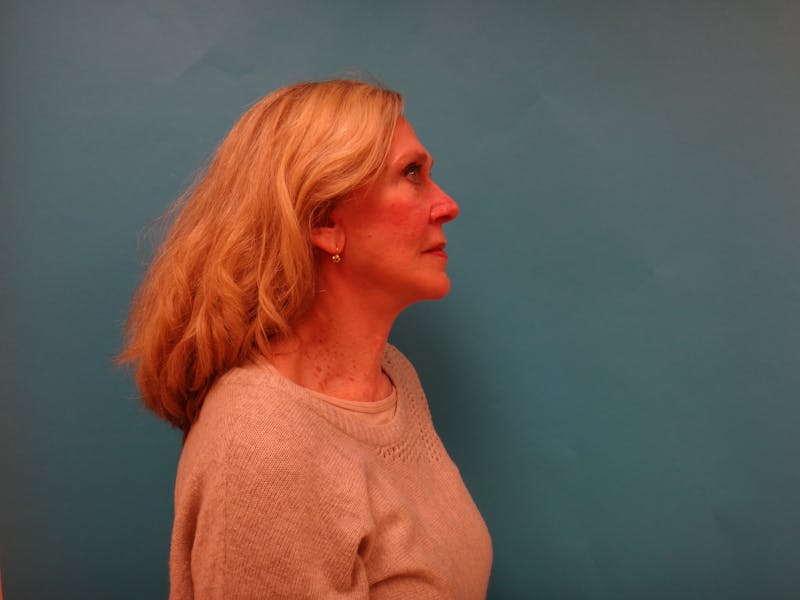 Facelift Before & After Gallery - Patient 261903 - Image 4