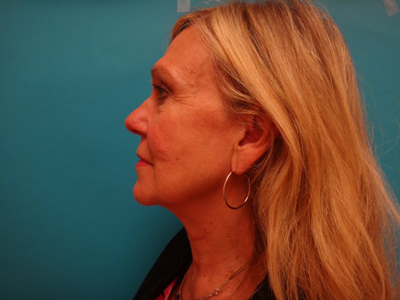 Facelift Before & After Gallery - Patient 261903 - Image 5