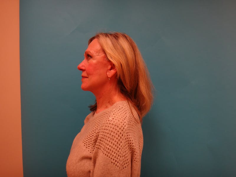 Facelift Before & After Gallery - Patient 261903 - Image 6