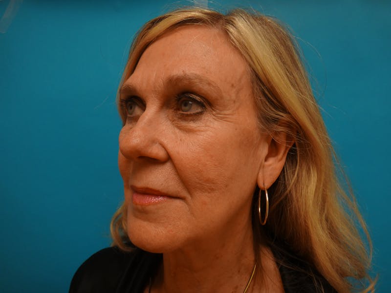 Facelift Before & After Gallery - Patient 261903 - Image 7