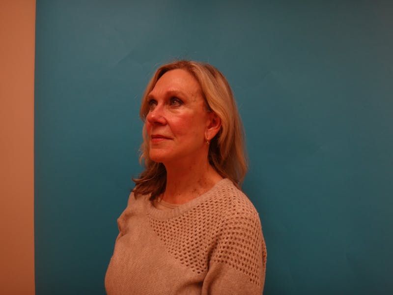 Facelift Before & After Gallery - Patient 261903 - Image 8