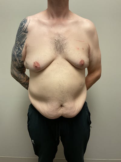 Gynecomastia Before & After Gallery - Patient 120675 - Image 1