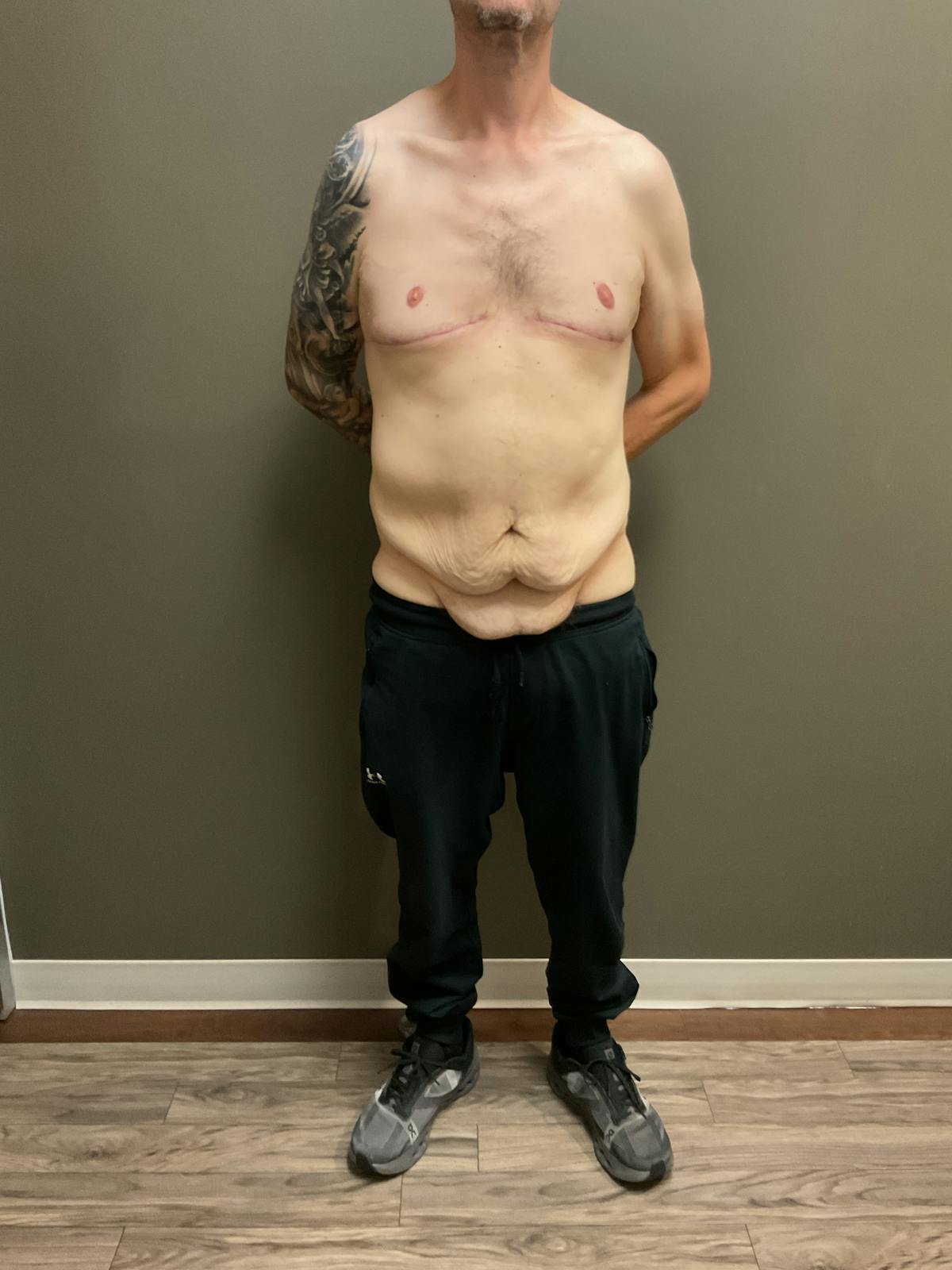 Gynecomastia Before & After Gallery - Patient 120675 - Image 2