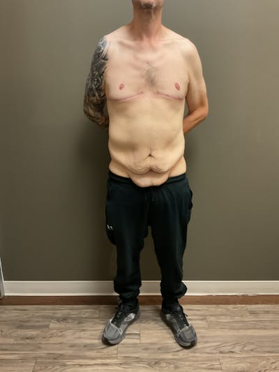 Gynecomastia Before & After Gallery - Patient 120675 - Image 2