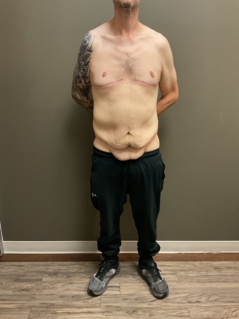Gynecomastia Before & After Gallery - Patient 120675 - Image 2