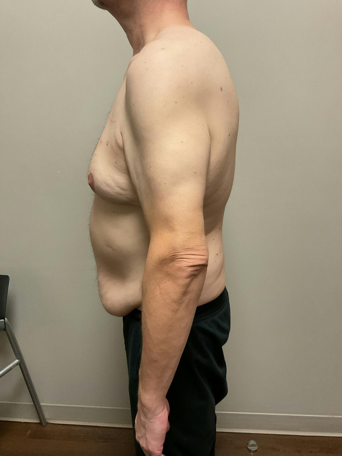 Gynecomastia Before & After Gallery - Patient 120675 - Image 3