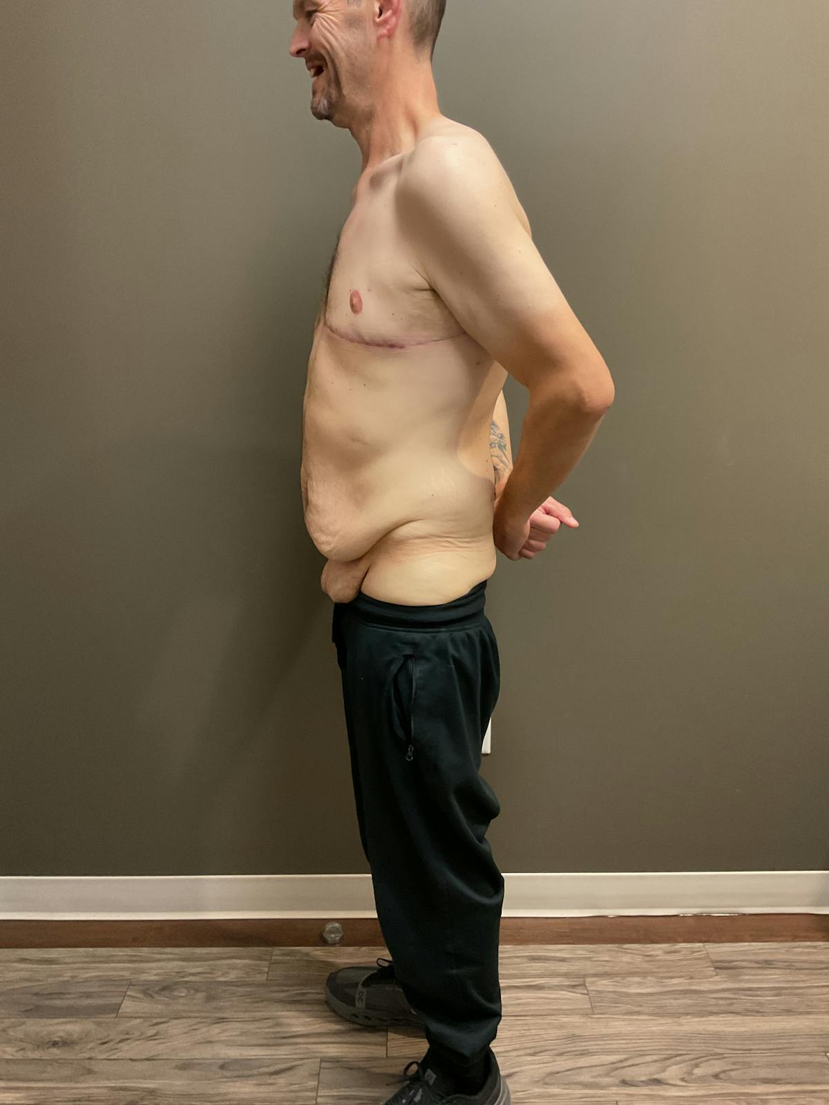 Gynecomastia Before & After Gallery - Patient 120675 - Image 4