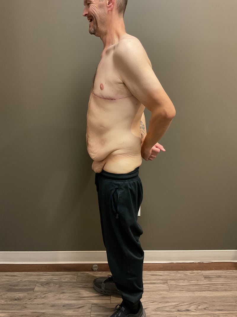 Gynecomastia Before & After Gallery - Patient 120675 - Image 4