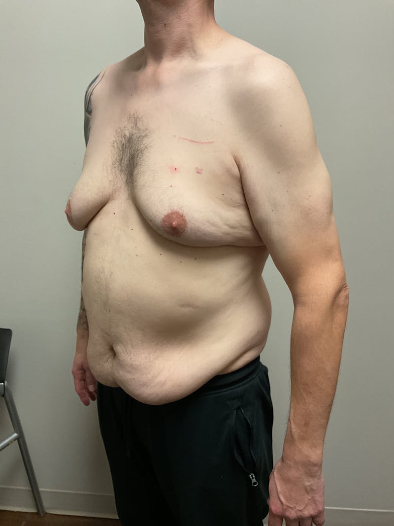 Gynecomastia Before & After Gallery - Patient 120675 - Image 5