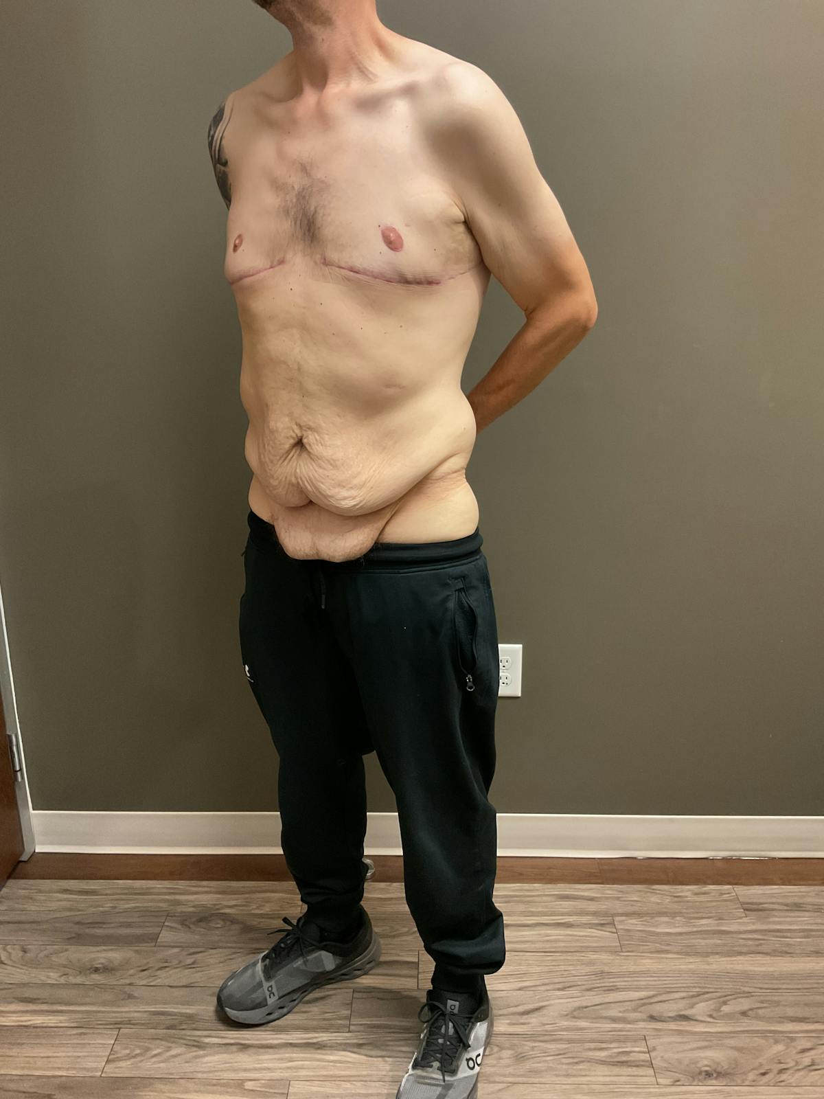 Gynecomastia Before & After Gallery - Patient 120675 - Image 6