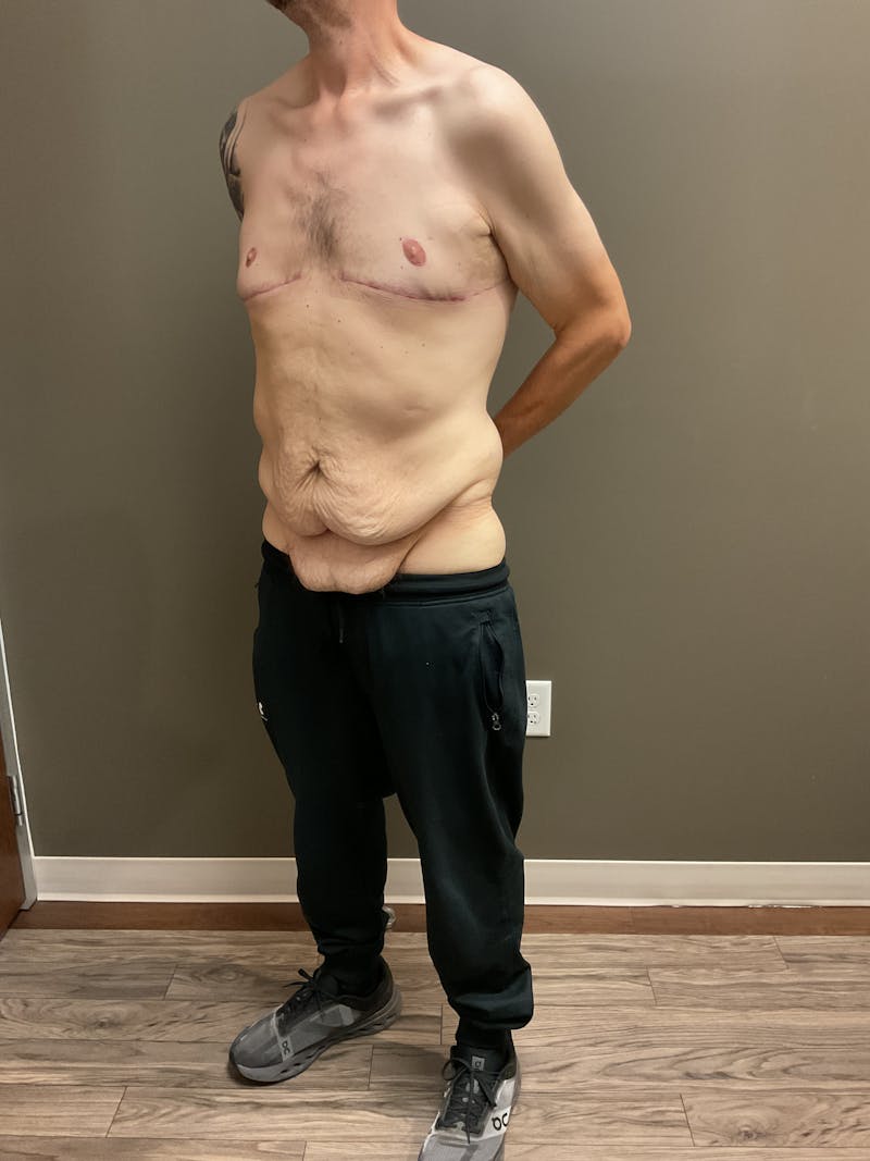 Gynecomastia Before & After Gallery - Patient 120675 - Image 6