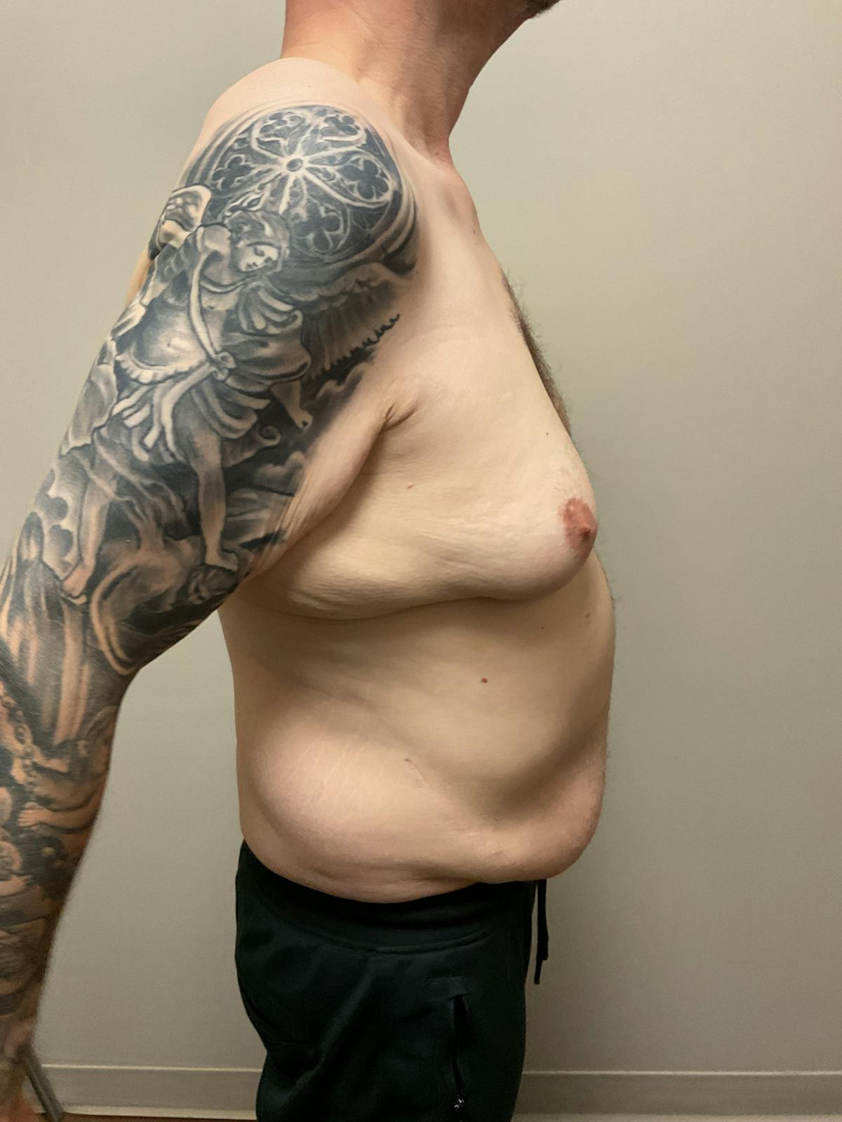 Gynecomastia Before & After Gallery - Patient 120675 - Image 7