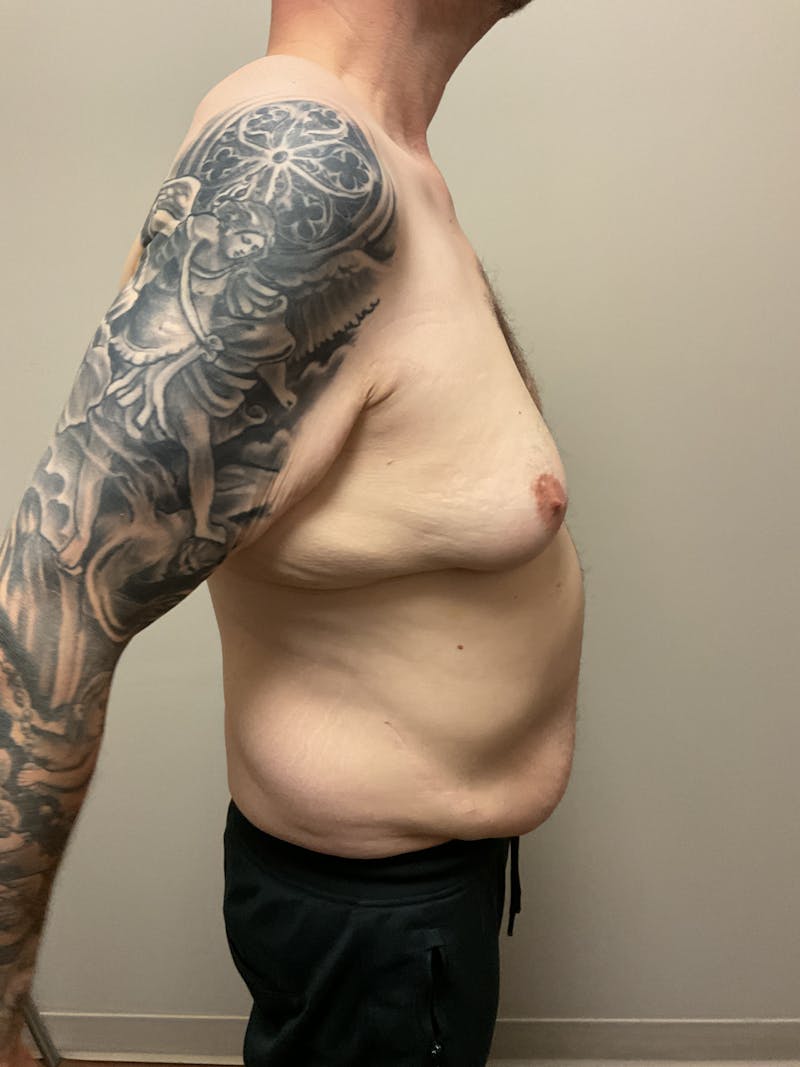 Gynecomastia Before & After Gallery - Patient 120675 - Image 7