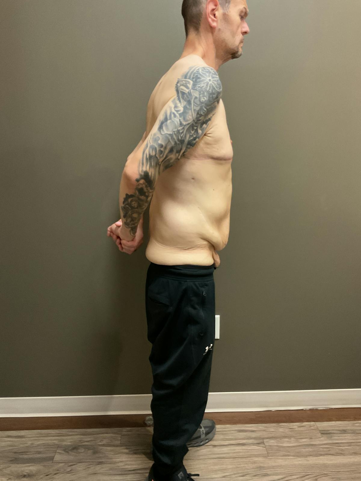 Gynecomastia Before & After Gallery - Patient 120675 - Image 8