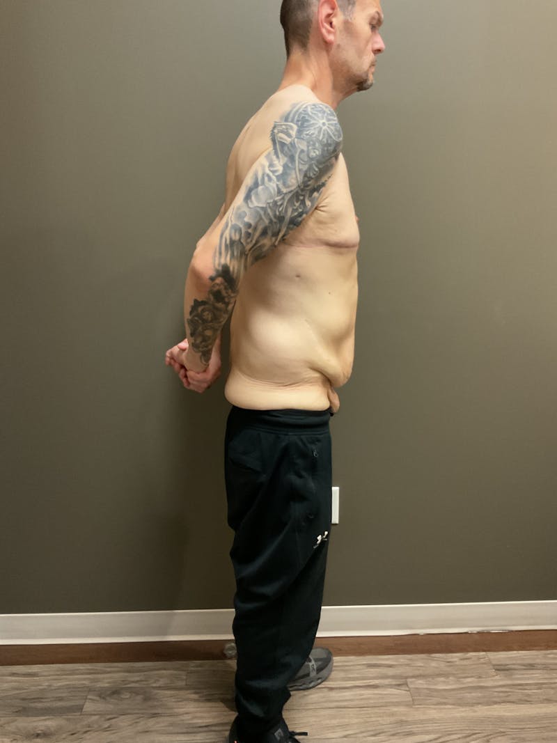 Gynecomastia Before & After Gallery - Patient 120675 - Image 8