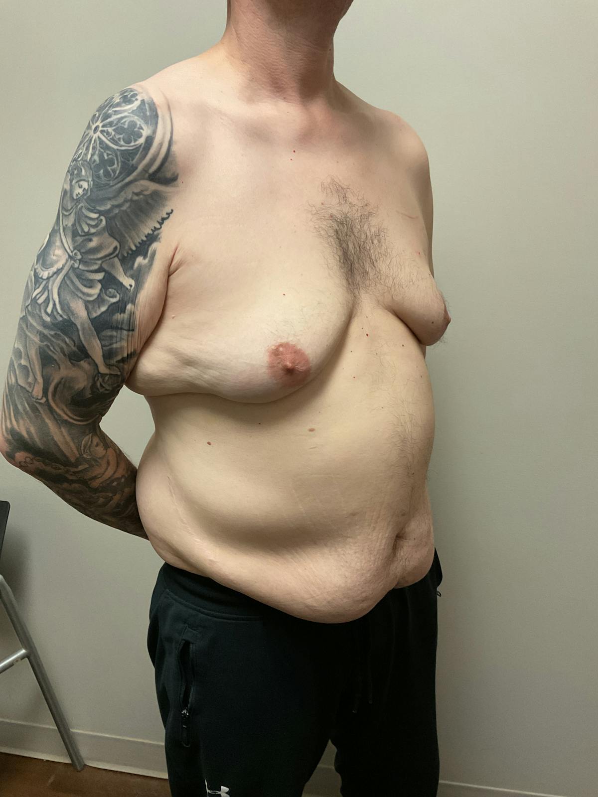 Gynecomastia Before & After Gallery - Patient 120675 - Image 9